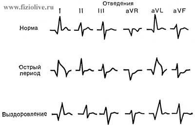 ECG in violation of the coronary circulation