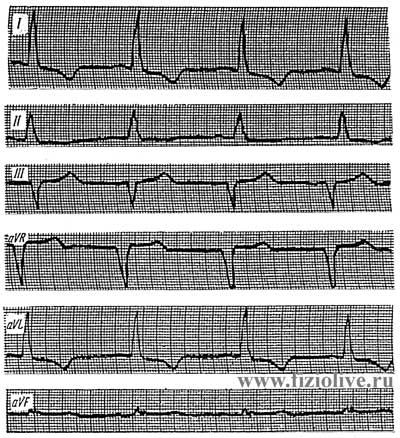 Electrocardiogram 1 in left ventricular hypertrophy