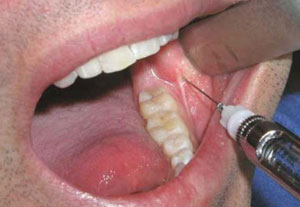 обезболивание у стоматолога