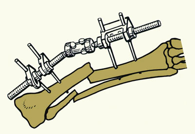 Стержневой дистракционно-компрессионный аппарат СКИД на костях голени до репозиции отломков