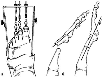 Скелетное вытяжение при переломах плюсневых костей и фаланг пальцев стопы