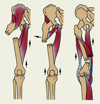 Схематическое изображение типичных смещений отломков бедренной кости в зависимости от уровня перелома