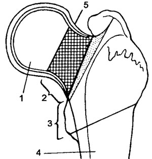Схема переломов проксимальной части бедренной кости